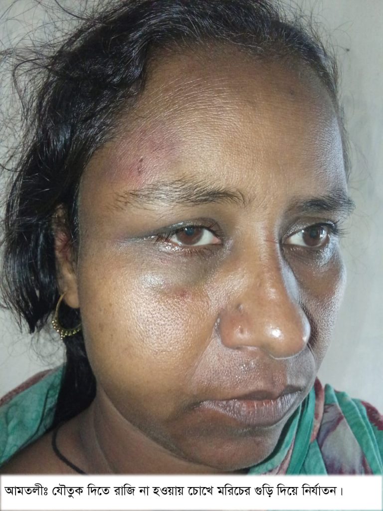 যৌতুক দিতে রাজি না হওয়ায় স্ত্রীর চোখে মরিচের গুড়ি দিয়ে নির্যাতন